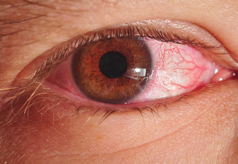 ØYNENE KAN VISE SYMPTOMER PÅ SYKDOM: En lege kan rask få et inntrykk av en persons allmenntilstand ved å se på øynene. Mannen som har fått øyet avbildet her lider av øyekatarr.