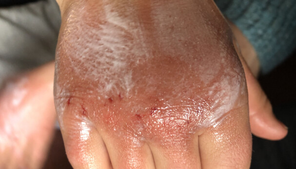 VONDT: Mange barn sliter med sprukket hud og såre hender.