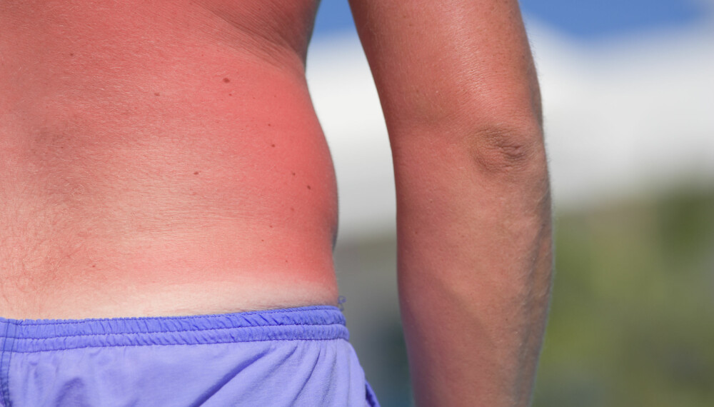 BETENNELSE: Ved solbrenthet vil huden som regel bli rød, sviende, kløene og hoven.