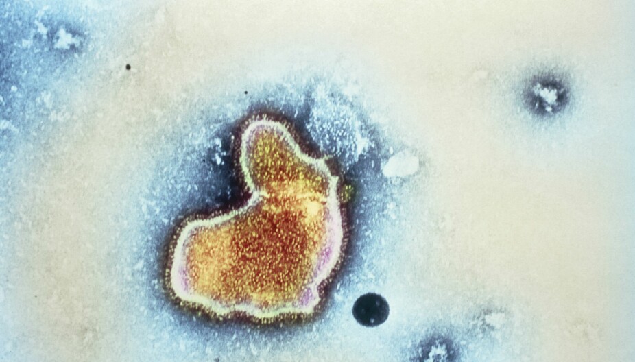 RS-VIRUS: Et mikroskop-bilde viser Respiratorisk-syncytialt virus, som er et virus som overføres med sekret fra luftveiene, via luftsmitte og med forurensede hender Viruset rammer særlig barn under 5 år.