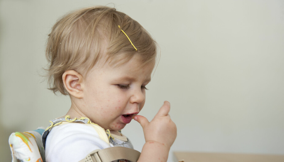 HÅND-, FOT,- OG MUNNSYKDOM: Barn som får denne sykdommen får blemmer rundt og i munnen, på hender og føtter.