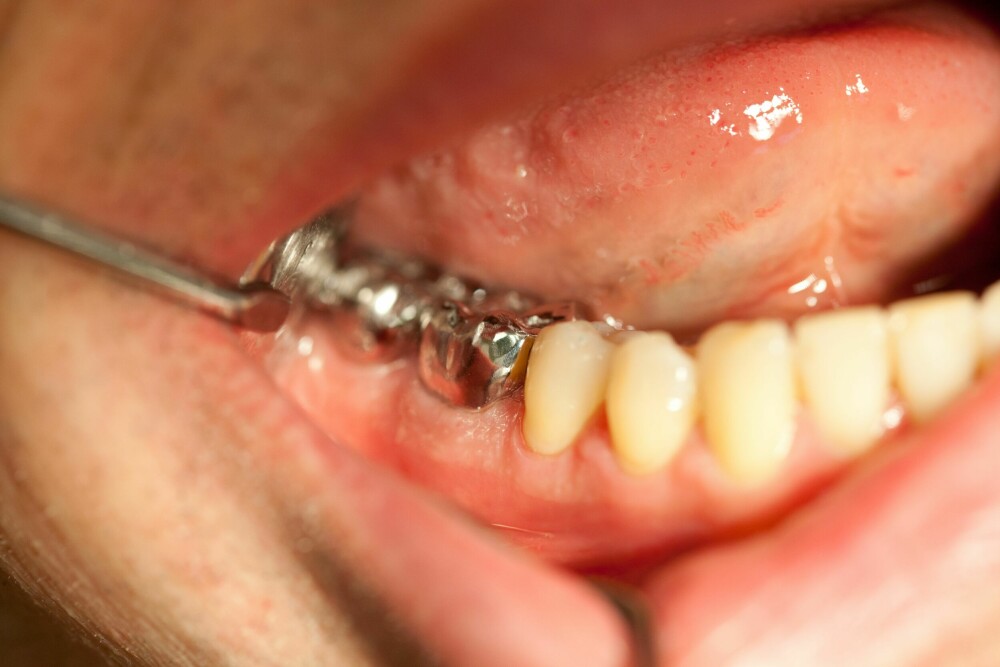<b>ELENDIG VEKSLINGSKURS:</b> Få kroner er dyrere i innkjøp enn de som erstatter ødelagte tenner i munnen. Amalgam krevde store fyllinger som svekket tennene. Og når tenner knekker, er kroner ofte resultatet.