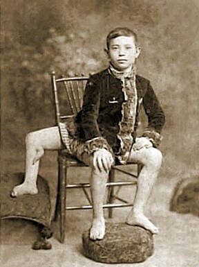 HVILENDE FOT: Italienskfødte Frank Lentini hadde et tredje ben fra en parasittisk tvilling ut av ryggen. Lentini spøkte ofte med at han hadde tre ben, men likevel ikke et par. Ingen av bena var like lange. Her avbildet som barn.
