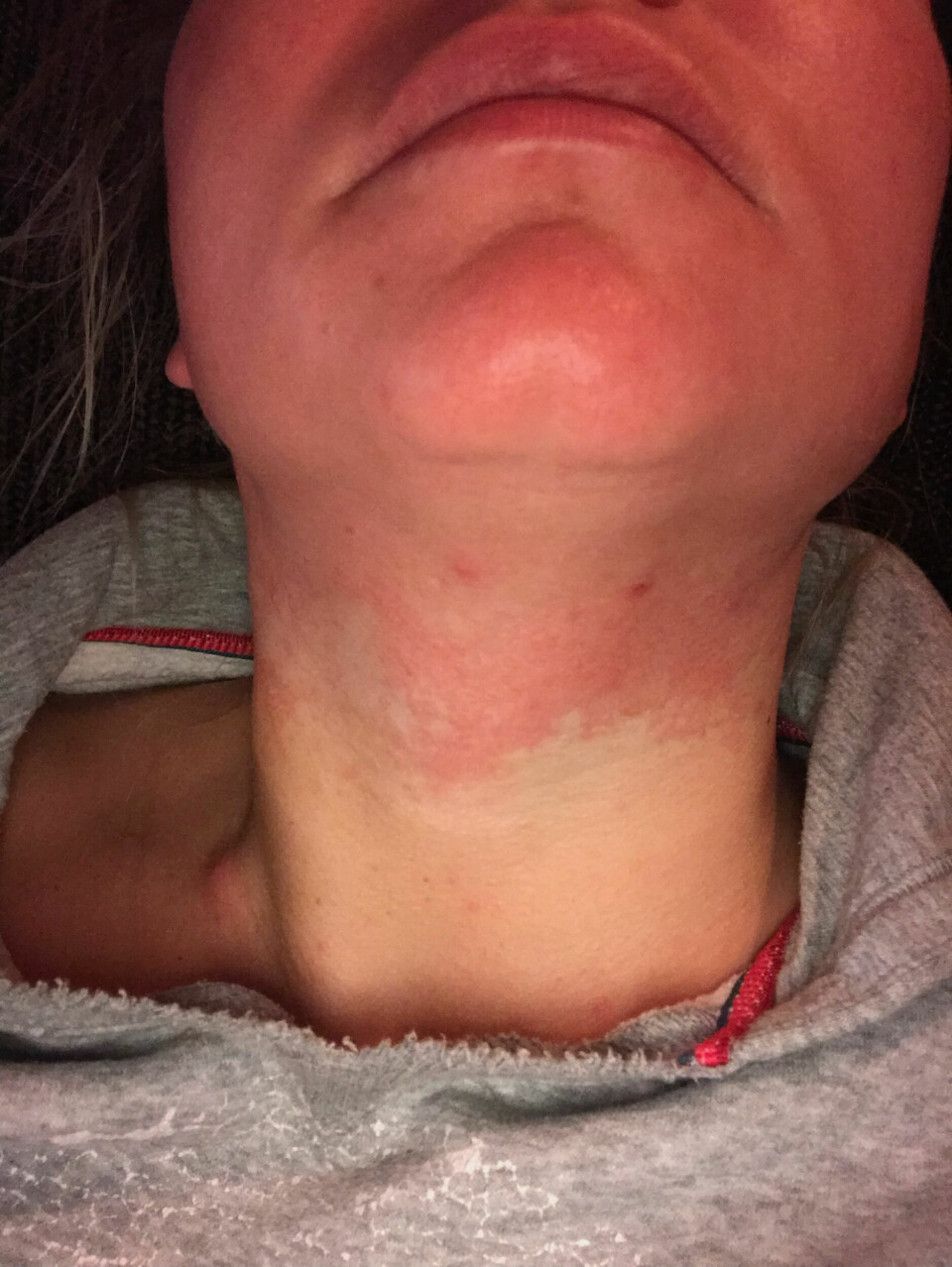 UTSLETT: Henriette fikk plutselig rødt utslett på hals og i ansikt og små kuler på halsen. En stund mistet hun også hår på hodet og fikk åpne sår på hendene