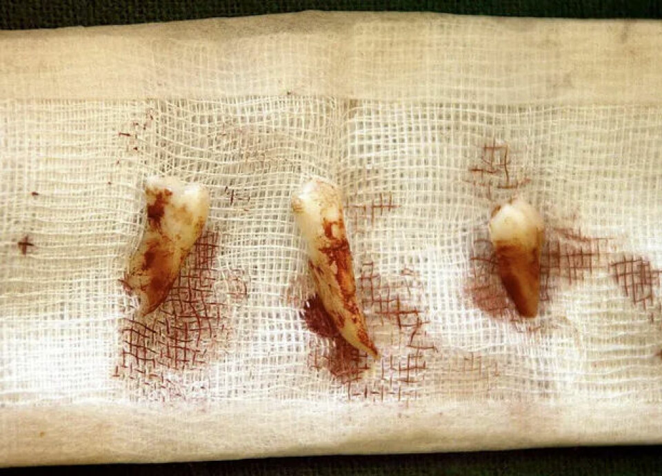 UTSLÅTT: Battistons tenner.