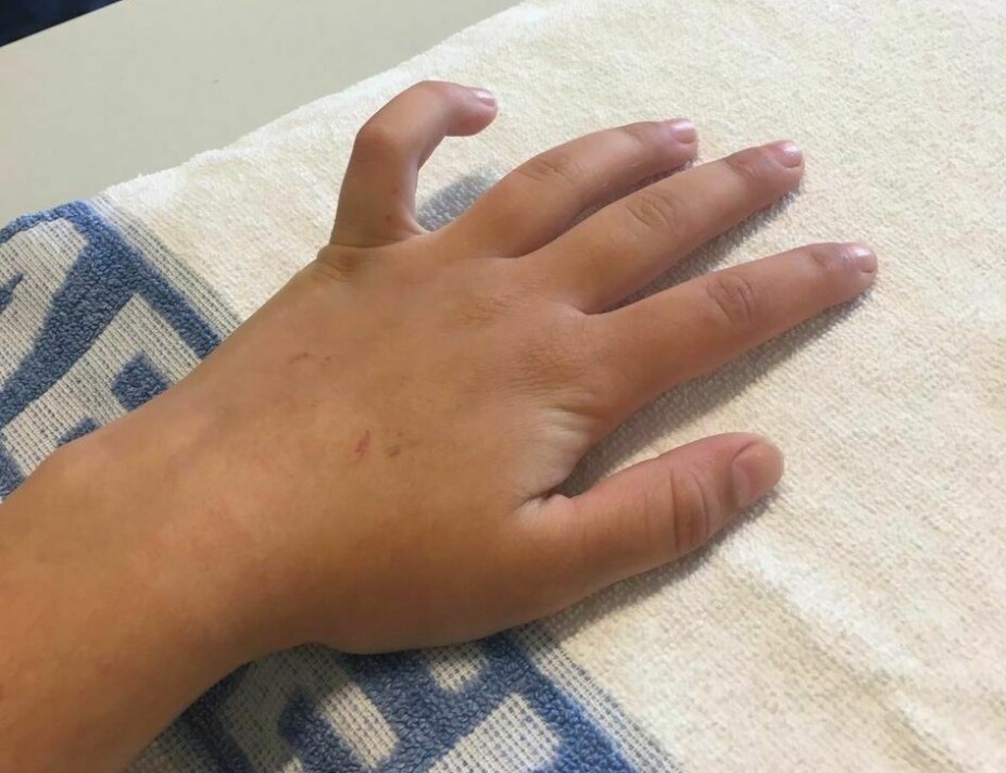 FINGER: Kjerstin har levd med en finger formet som en krok i to år. Legene har enda ikke funnet en måte å helbrede den på.