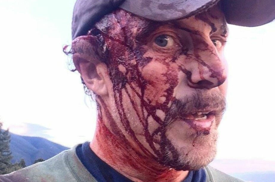 <b>GRIZZLY-SELFIE:</b> Todd tok bilder for å dokumentere skadene etter det brutale bjørneangrepet.