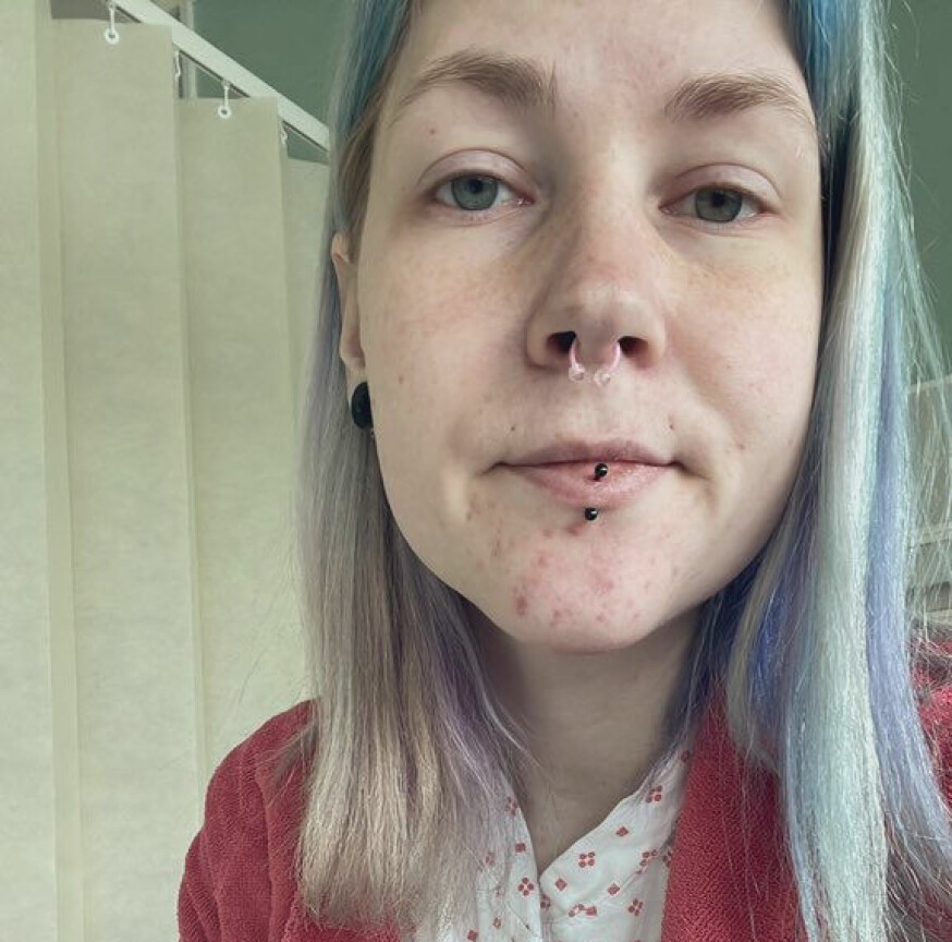 KLAR FOR INNGREPET: Her er Hanne kort tid før steriliseringen skal gjennomføres.