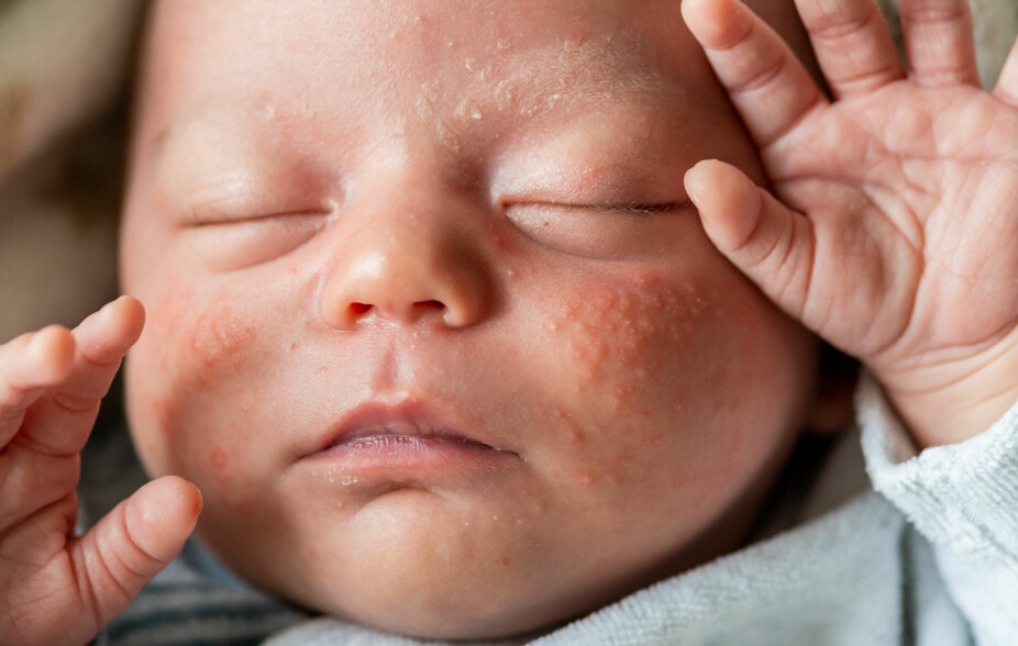 HORMONUTSLETT BABY: Utslettet skyldes talgkjertlene til barnet. Det ser ut som kviser, der det er små prikker med hvit tupp i midten, omringet av rødhet. Oppstår som oftest i ansiktet.