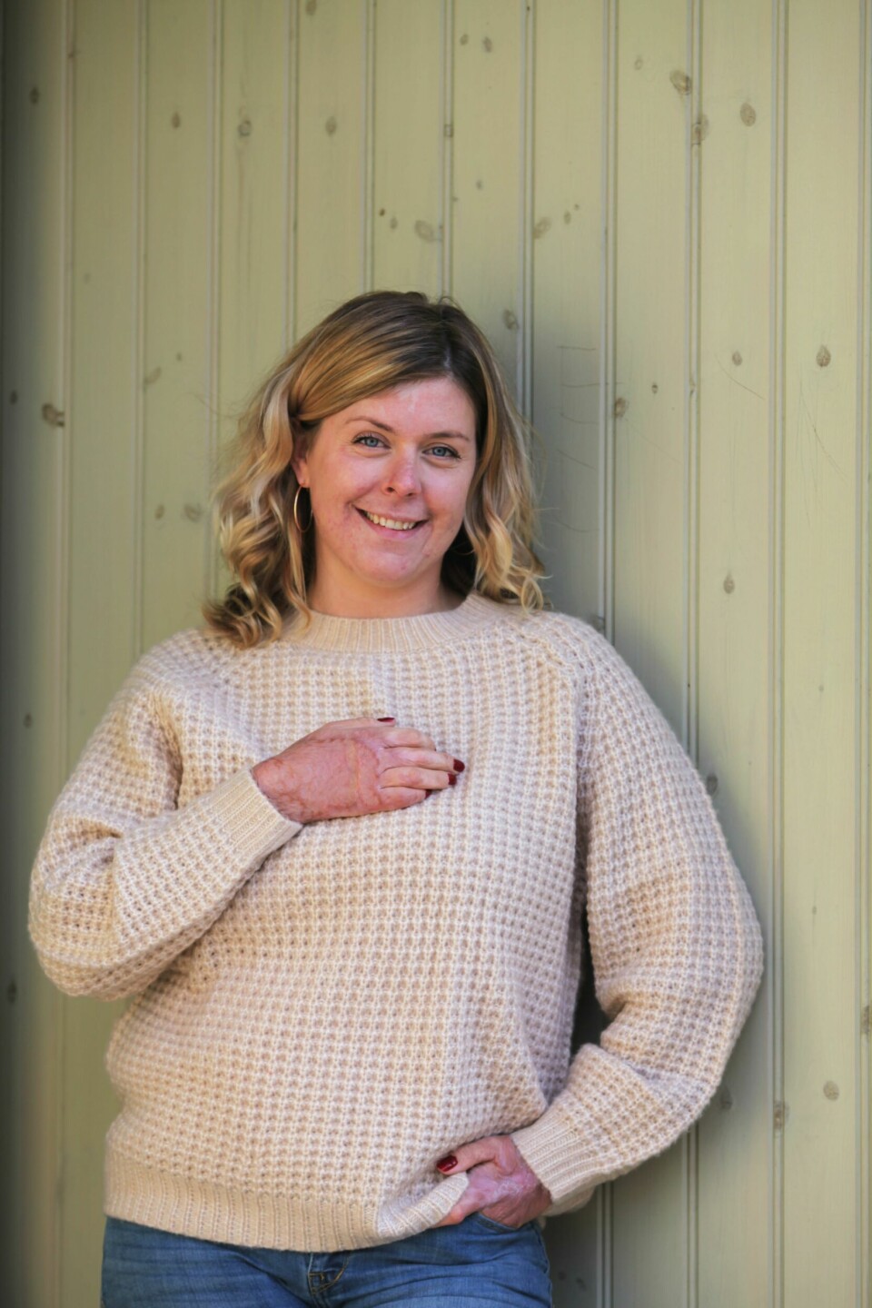 TAKKNEMLIG: Emma er i dag takknemlig for at hun overlevde. Arrene etter brannskadene har hun overalt, blant annet på hendene.