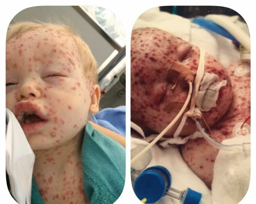 ADVARER: Bruk av Ibux og Nurofen ved vannkopper kan få store konsekvenser. Her er et sjeldent tilfelle med Isak (11mnd) i 2016, hvor han fikk Nurofen. Etter 24 timer så han slik ut. Årsaken var infeksjon i hud og bløtvev. I dag er Isak helt frisk.