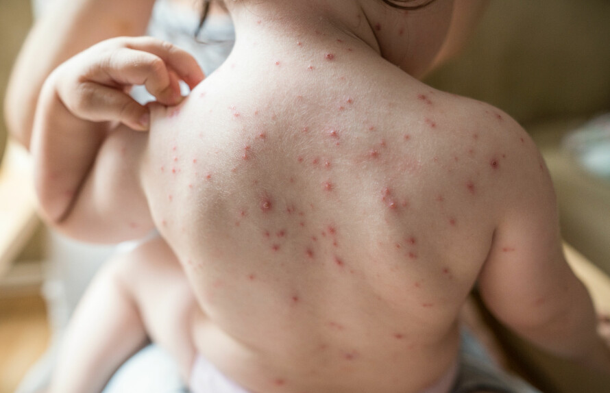 VANNKOPPER: Vannkopper kjennetegnes av blemmer med klar væske i. Etter hvert sprekker blemmene og vil bli til skorper.