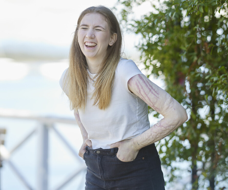VIL IKKE SKJULE ARRENE: I mange år brukte Hedda Mathea Kastås tid på å skjule arrene sine. Det vil hun ikke gjøre lenger.