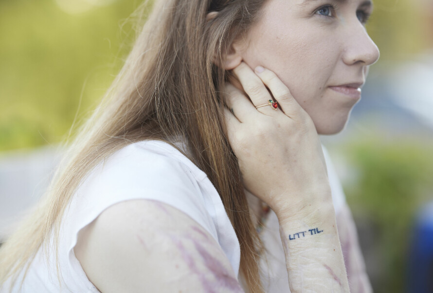 FOLK STIRRER: Hedda kan noen ganger føle seg som et sirkusdyr fordi folk stirrer på armene hennes.