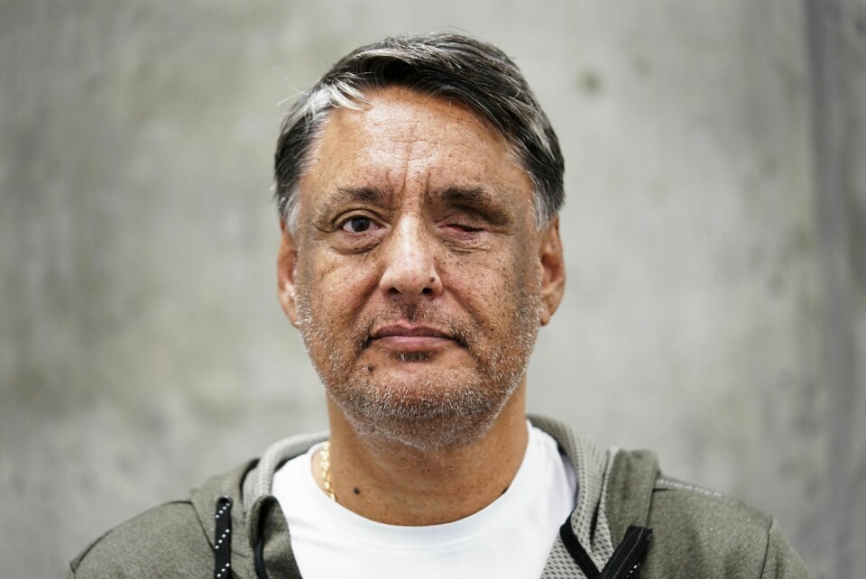 UTEN ØYE: Akutt sykdom kostet Kennet Dillen hans venstre øye.