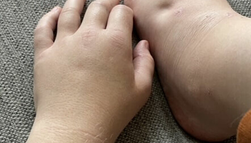 FØR INNLEGGELSE: Celine hadde hovne hender og føtter, og sår som ikke ville gro.