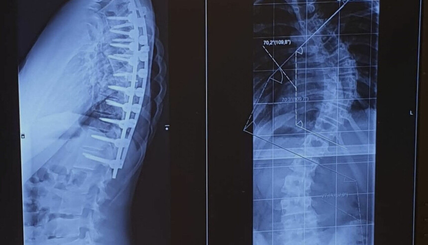 SKOLIOSE: Røntgenbilde av ryggen til Eline.