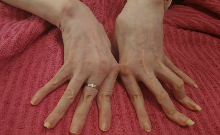 UTE AV LEDD: Anne-Stine sine fingre er preget av en leddsykdom som gjør at de lett går ut av ledd.