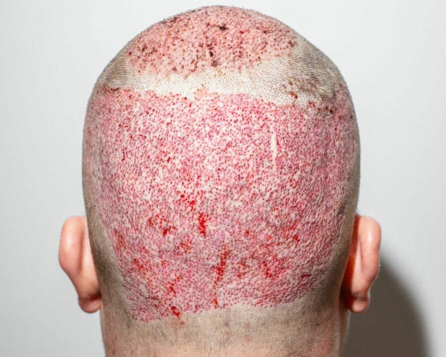 <b>BLODIG:</b> Bakhodet til britiske Matt Shane (31), én dag etter utført hårtransplantasjon.