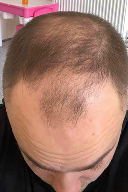 <b>FORANDRING …:</b> Matt Shane (31) før hårtransplantasjon. 