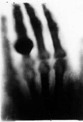 <b>UNDER HUDEN:</b> Wilhelm Röntgen brukte hånden til kona som motiv for noen av sine første røntgen­bilder. 