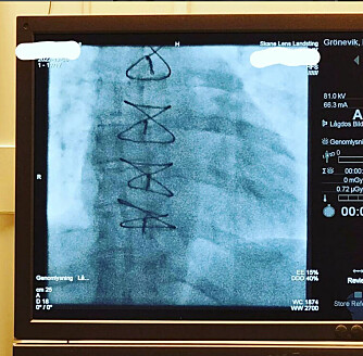 <b>SYDD:</b> – På røntgenbildet ser dere mitt igjensydde bryst. Fem i håndarbeid, sier Isabel med galgenhumor.