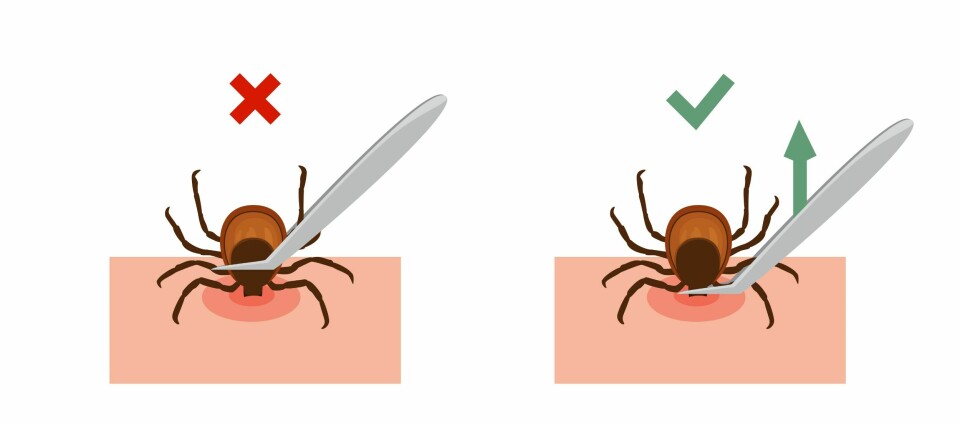 FJERNING: Sånn fjerner du flåtten med pinsett. Ta tak så langt ned på insektet du klarer og napp det rett ut.