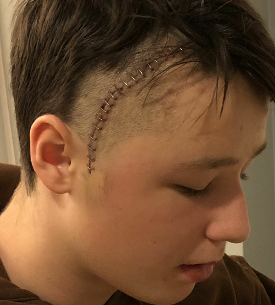 STORT ARR: Etter at Gabriel (14) fikk operert vekk hjernesvulsten, hadde han et arr på ni centimeter. Arret har grodd fint og er i dag dekket av håret hans.