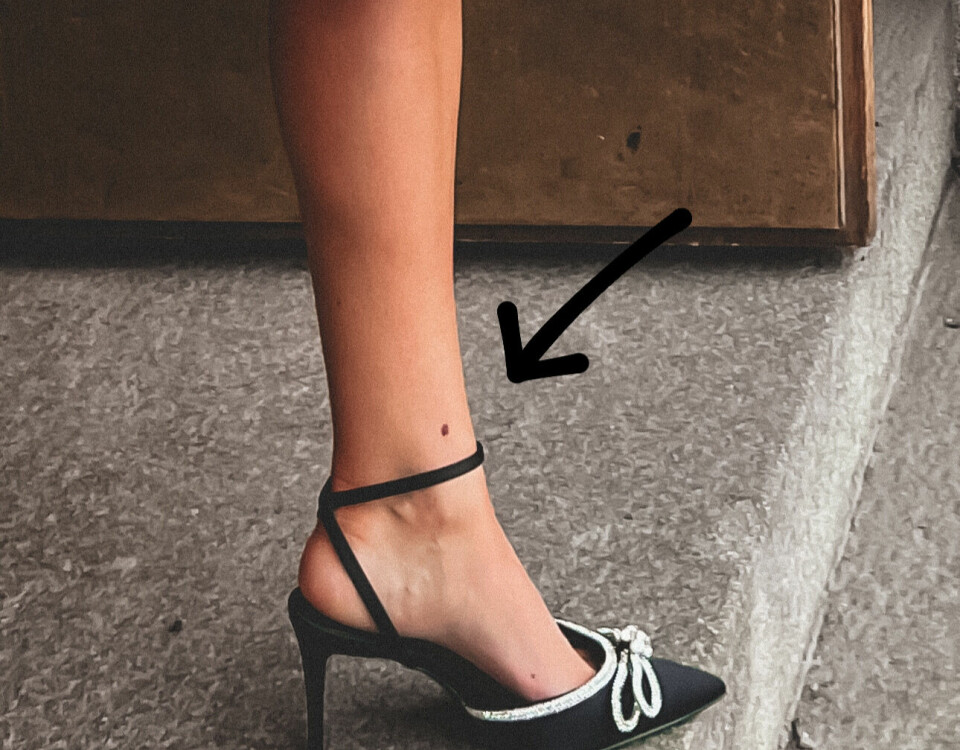 KOM FORT: Føflekken det ble funnet kreft i hadde vært på leggen i ett år da Marianne bestemte seg for å sjekke den.