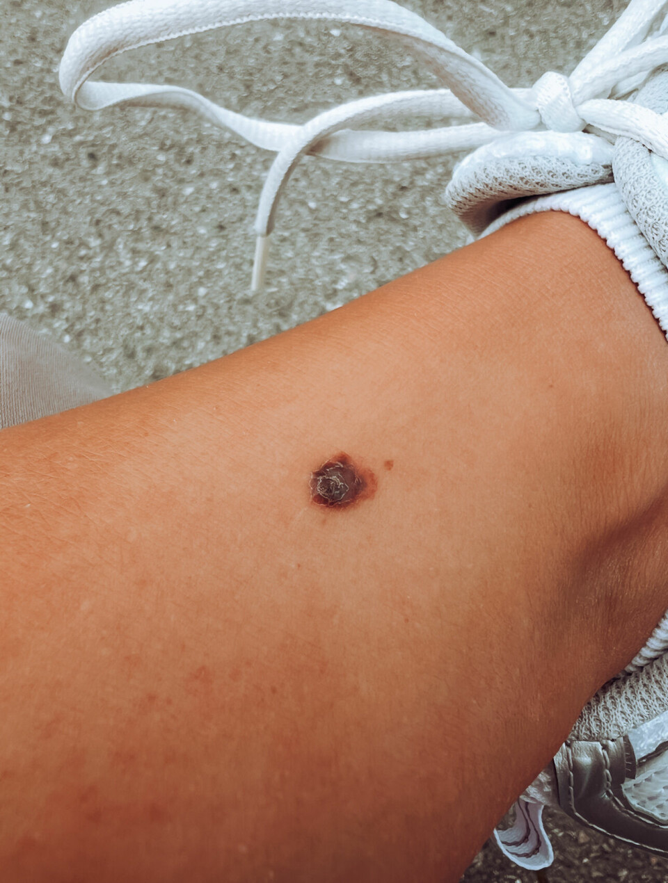 STOD UT: Føflekken sto litt ut og hadde vokst.