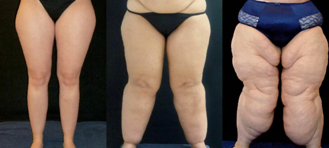 Fettet som ikke går bort under slankekuren