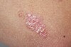 Nærbilde av rødt, skjellende psoriasisplakk på menneskehud
