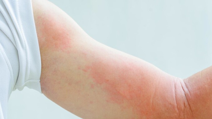 Barn dyreallergi - Allergi og utslett